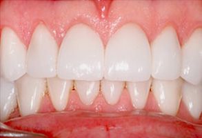 Randolph County Before and After Dental Implants