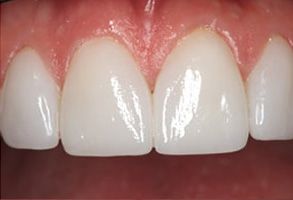 Randleman dental images
